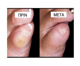 MEDFUSS - Λοσιόν Άμεσης Απομάκρυνσης Σκληρυνσεων Φτέρνας / Πέλματος Αφαιρεί την αντιαισθητικη κεράτινη στοιβάδα Χωρίς λίμες ελαφρόπετρες τρίψιμο και πόνο!