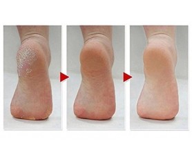 MEDFUSS - Λοσιόν Άμεσης Απομάκρυνσης Σκληρυνσεων Φτέρνας / Πέλματος Αφαιρεί την αντιαισθητικη κεράτινη στοιβάδα Χωρίς λίμες ελαφρόπετρες τρίψιμο και πόνο!